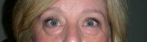 Patient 60 - Lower Blepharoplasty - Before