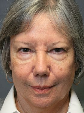 Patient 66 - Lower Blepharoplasty - Before