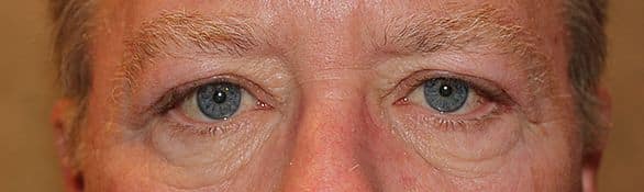 Patient 74 - Upper Blepharoplasty - Upper Eyelid Surgery - After