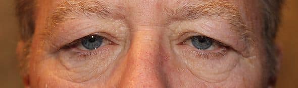 Patient 74 - Upper Blepharoplasty - Upper Eyelid Surgery - Before