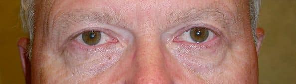 Patient 78 - Upper Blepharoplasty - Upper Eyelid Surgery - After