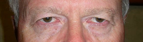 Patient 78 - Upper Blepharoplasty - Upper Eyelid Surgery - Before