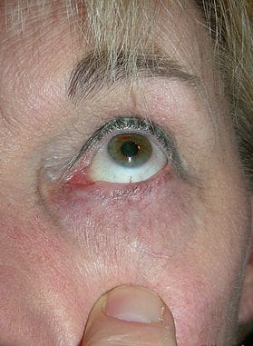Patient 8 - Skin Cancer of the Eye and Face - After