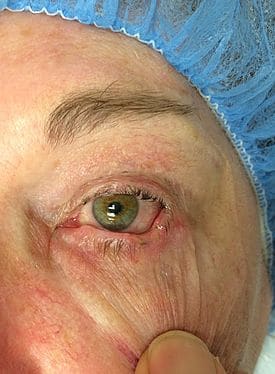 Patient 8 - Skin Cancer of the Eye and Face - Before