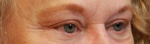 Patient 86 - Upper Blepharoplasty - Upper Eyelid Surgery - After