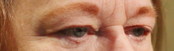 Patient 86 - Upper Blepharoplasty - Upper Eyelid Surgery - Before