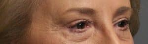 Patient 9 - Upper Blepharoplasty - Upper Eyelid Surgery - After