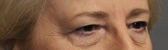 Patient 9 - Upper Blepharoplasty - Upper Eyelid Surgery - Before