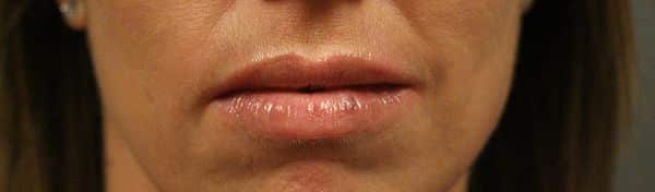 Patient 96 - Lip Filler - After