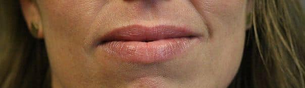 Patient 96 - Lip Filler - Before
