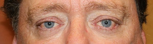 Patient 99 - Thyroid Eye Disease - Grves' Disease - After