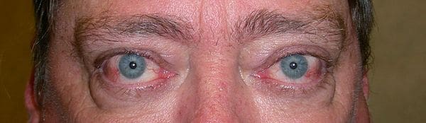 Patient 99 - Thyroid Eye Disease - Grves' Disease - Before