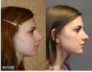 Rhinoplasty & Repair of the Nose - Cosmetic Surgery - TOC Eye and Face