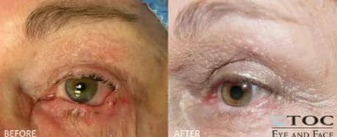 Skin Cancer of the Eye and Face - Reconstructive Surgery - TOC Eye and Face