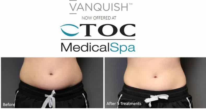 TOC Medical Spa now offers Vanquish!