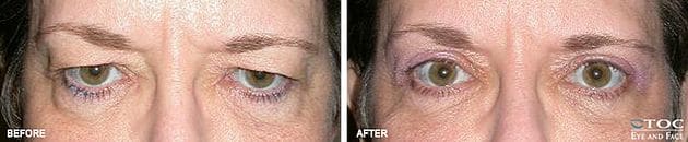 Upper Blepharoplasty 1 - Upper Eyelid Surgery - Cosmetic Surgery - TOC Eye and Face