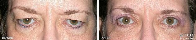 Upper Blepharoplasty 1 - Upper Eyelid Surgery - Reconstructive Surgery - TOC Eye and Face