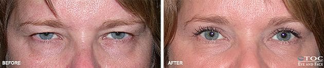 Upper Blepharoplasty 2 - Upper Eyelid Surgery - Cosmetic Surgery - TOC Eye and Face