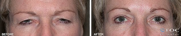 Upper Blepharoplasty 2 - Upper Eyelid Surgery - Reconstructive Surgery - TOC Eye and Face