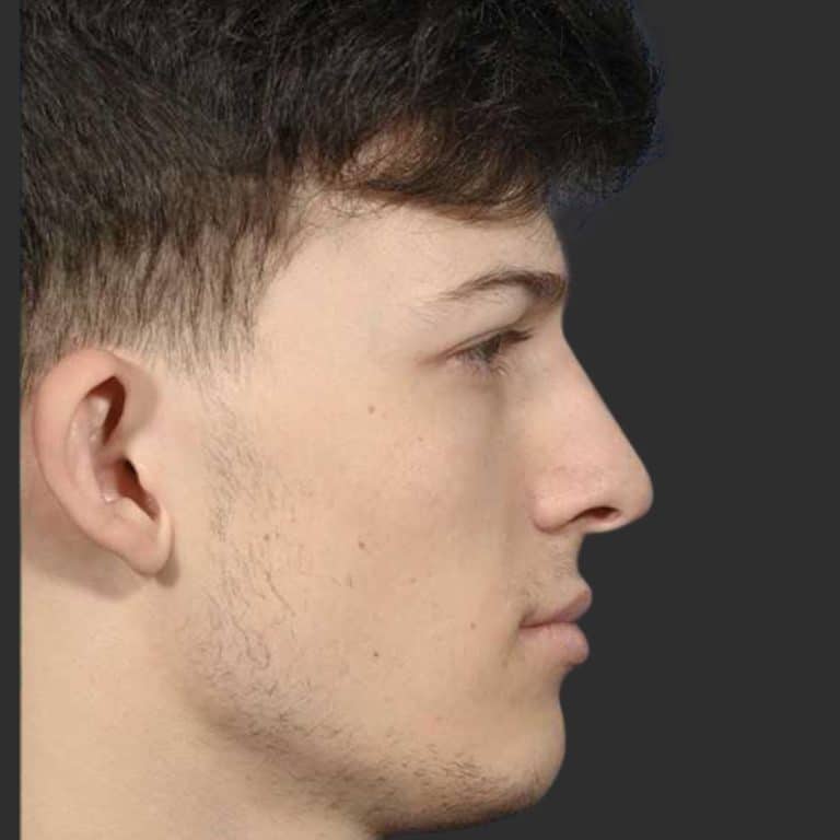 Rhinoplasty & Repair of the Nose - After