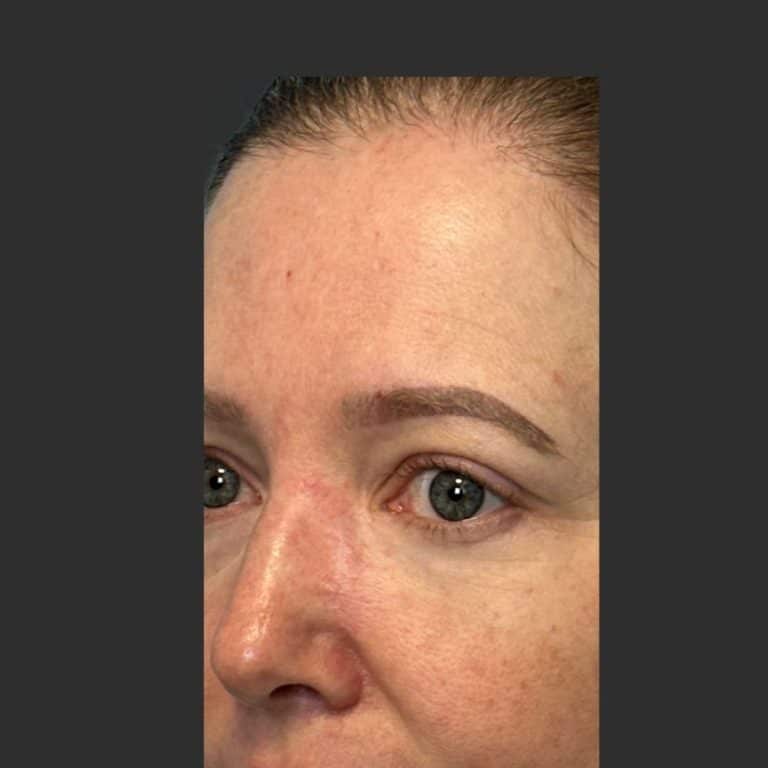 Skin Cancer Eye Area \ MOHS - After