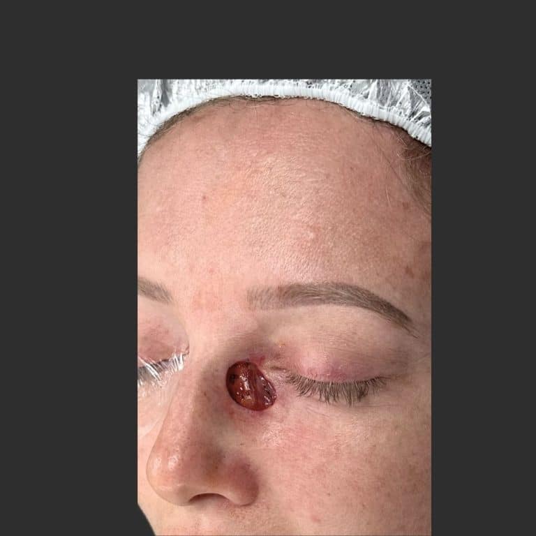 Skin Cancer Eye Area \ MOHS - Before