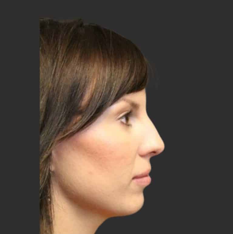 Rhinoplasty & Repair of the Nose - Before