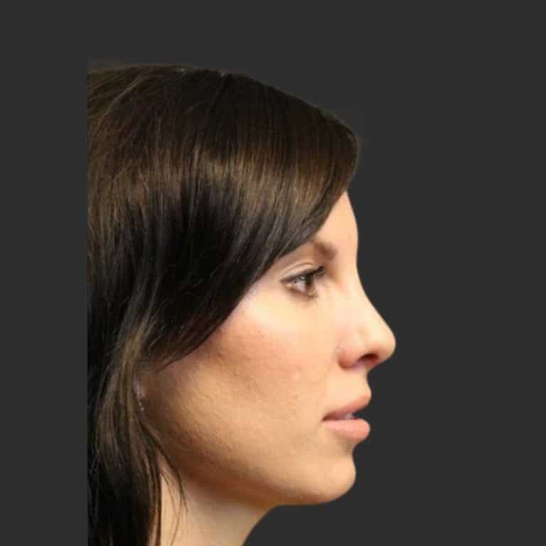 Rhinoplasty & Repair of the Nose - After