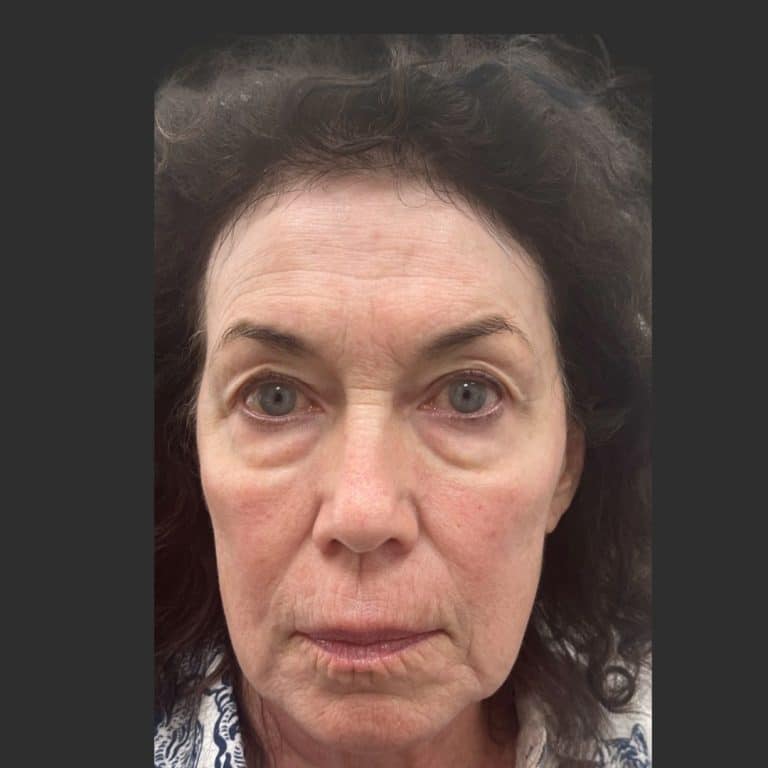 Upper Blepharoplasty - Before