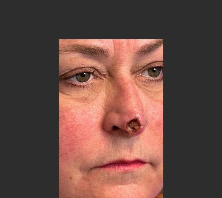 Skin Cancer of the Face - Before