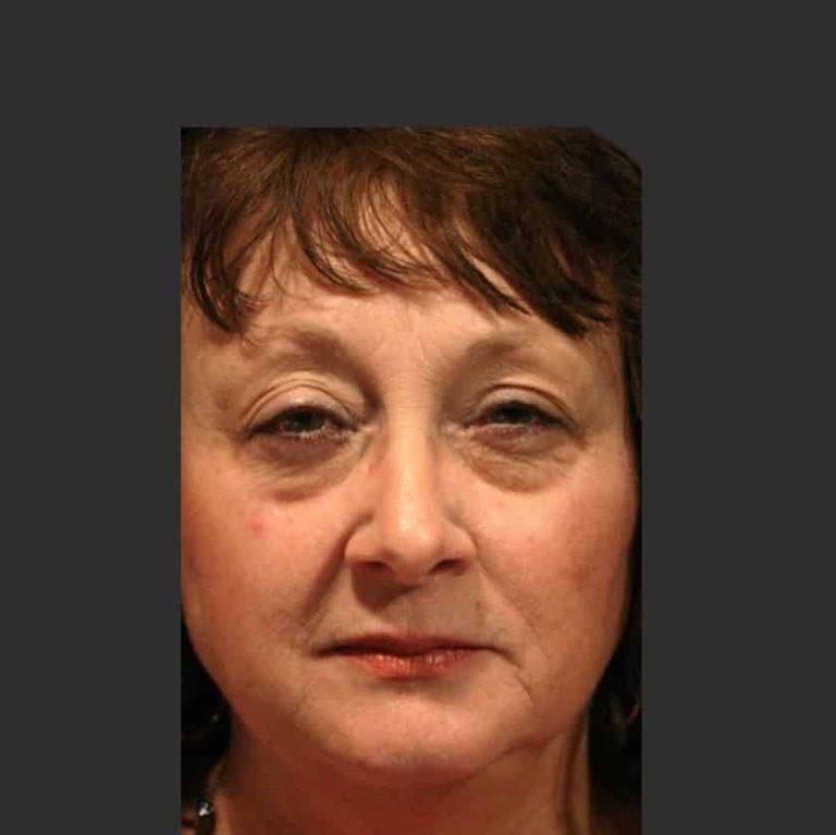 Upper Blepharoplasty - Before