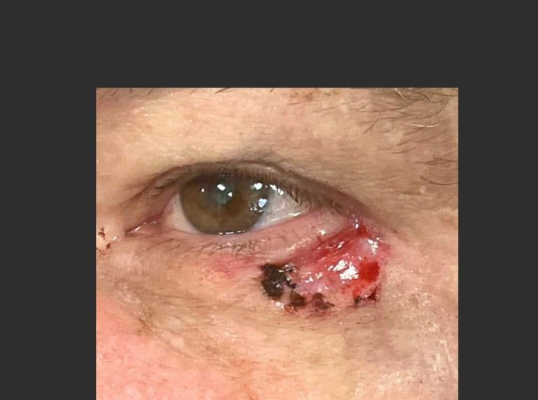 Skin Cancer of the Face - Before