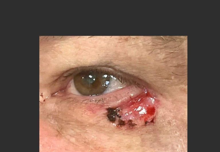 Skin Cancer of the Face - Before