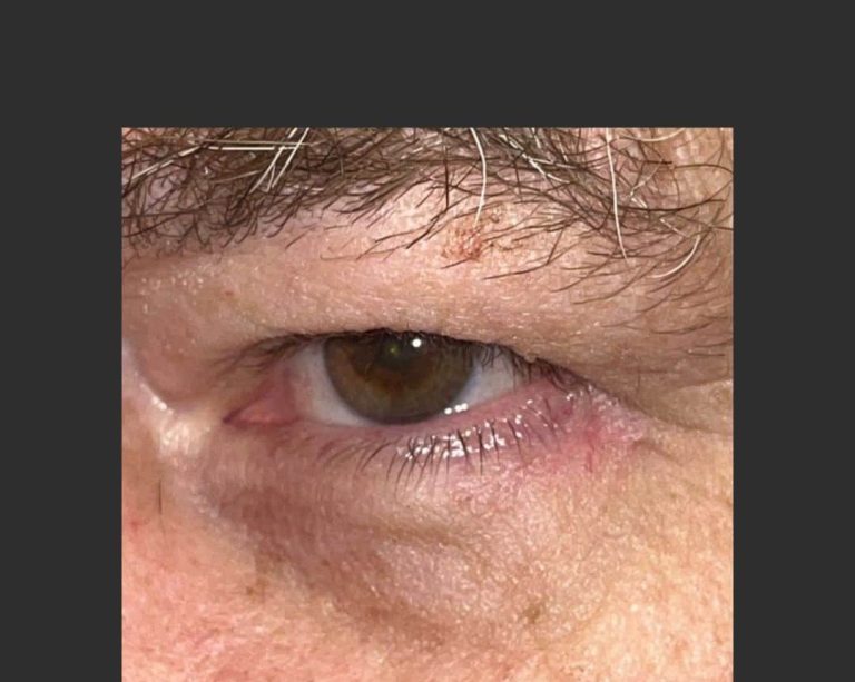 Skin Cancer of the Face - After