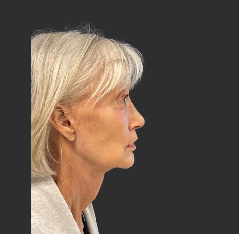 Face Lift & Neck Lift - After