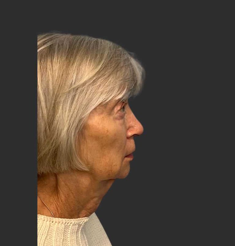 Face Lift & Neck Lift - Before