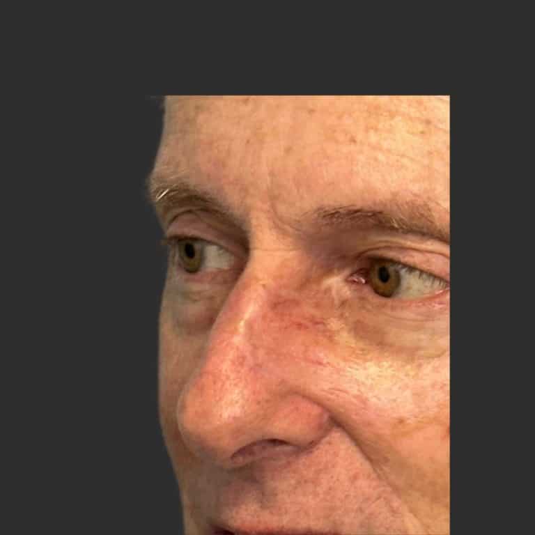 Skin Cancer of the Face - After