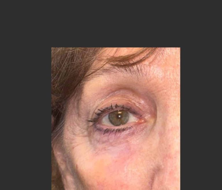Skin Cancer of the Face - After