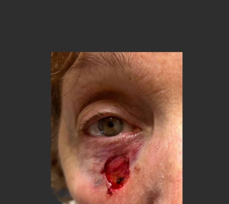 Skin Cancer of the Face - Before
