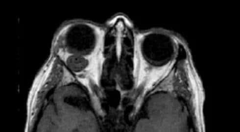 Orbital Tumors - Eye Socket Tumors - Reconstructive Surgery - TOC Eye and Face