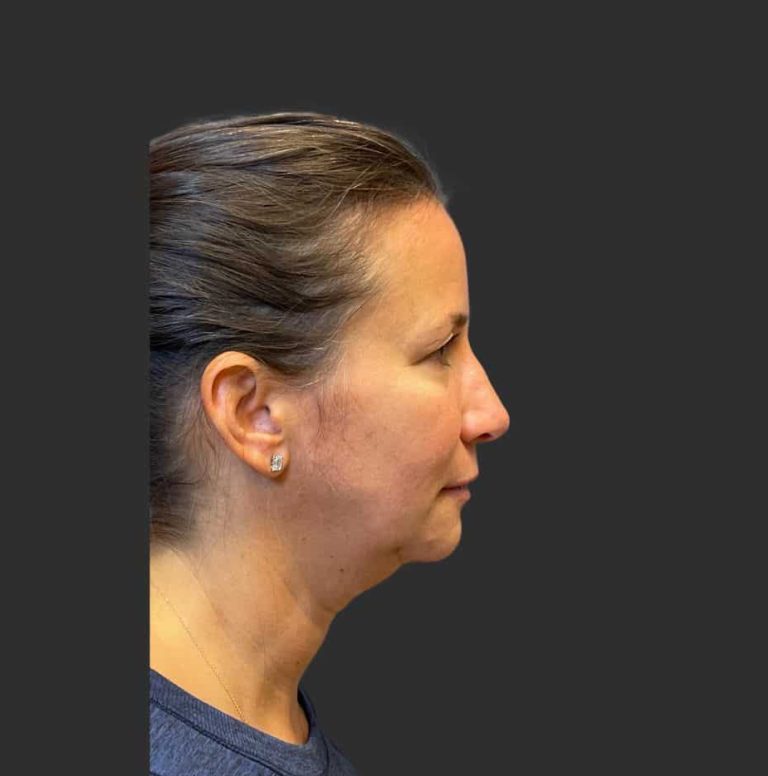 Face Lift & Neck Lift - Before