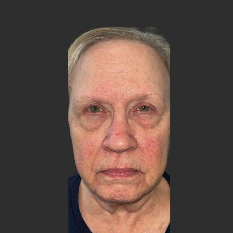 Eyelid Ptosis - Before