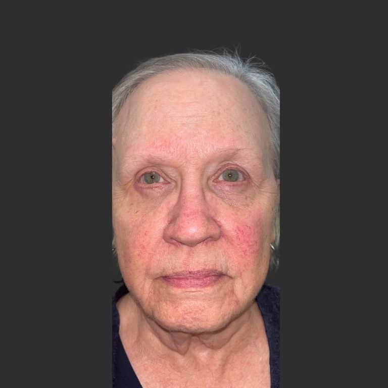 Eyelid Ptosis - After