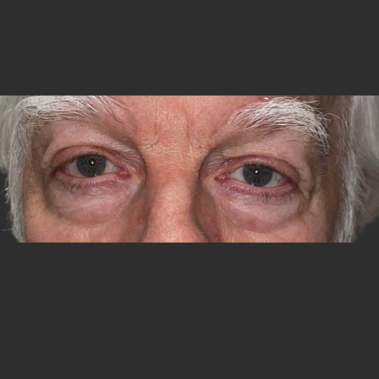 Ectropion (Eyelid Turning Out) - After