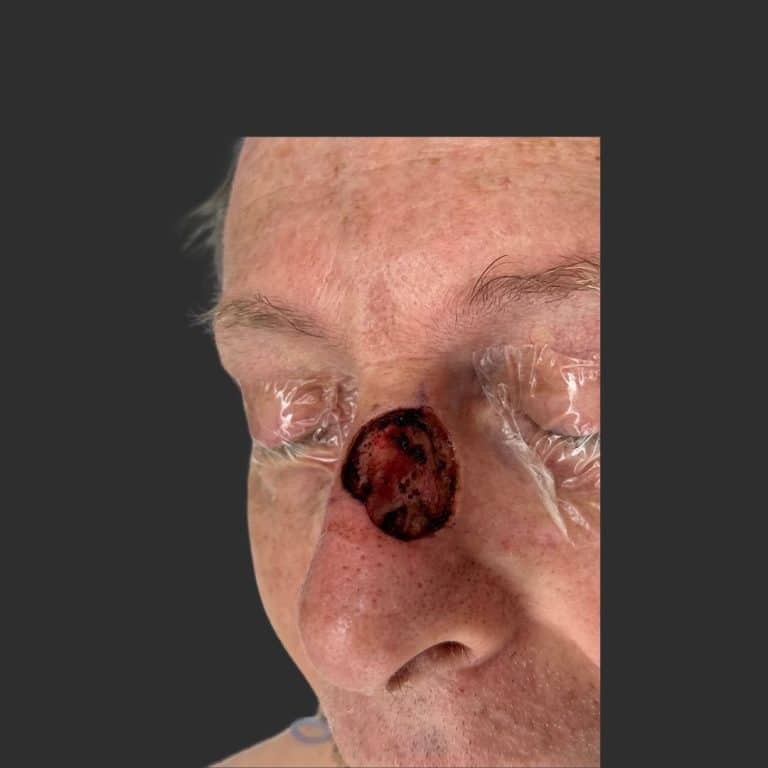 Skin Cancer of the Face - Before