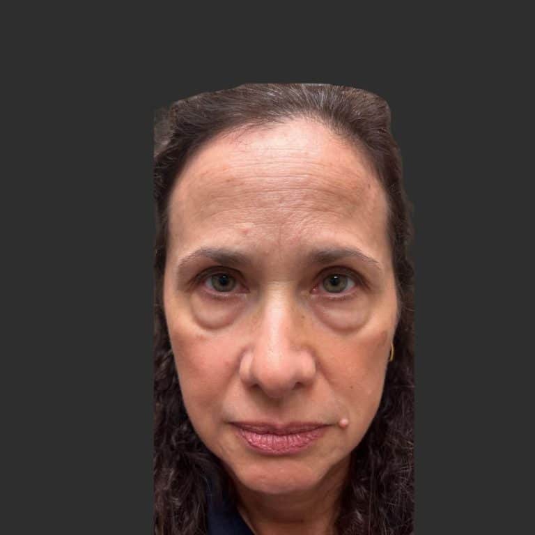 Lower Blepharoplasty - Before