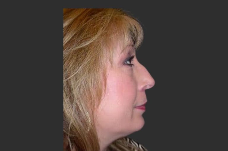 Rhinoplasty & Repair of the Nose - Before