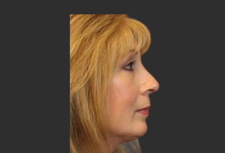 Rhinoplasty & Repair of the Nose - After