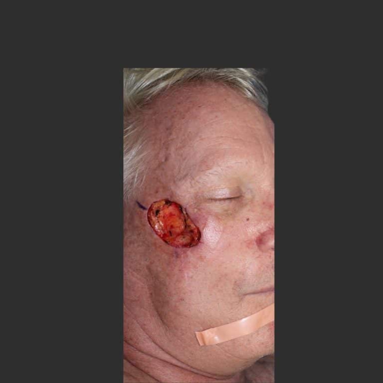 Skin Cancer of the Face - Before