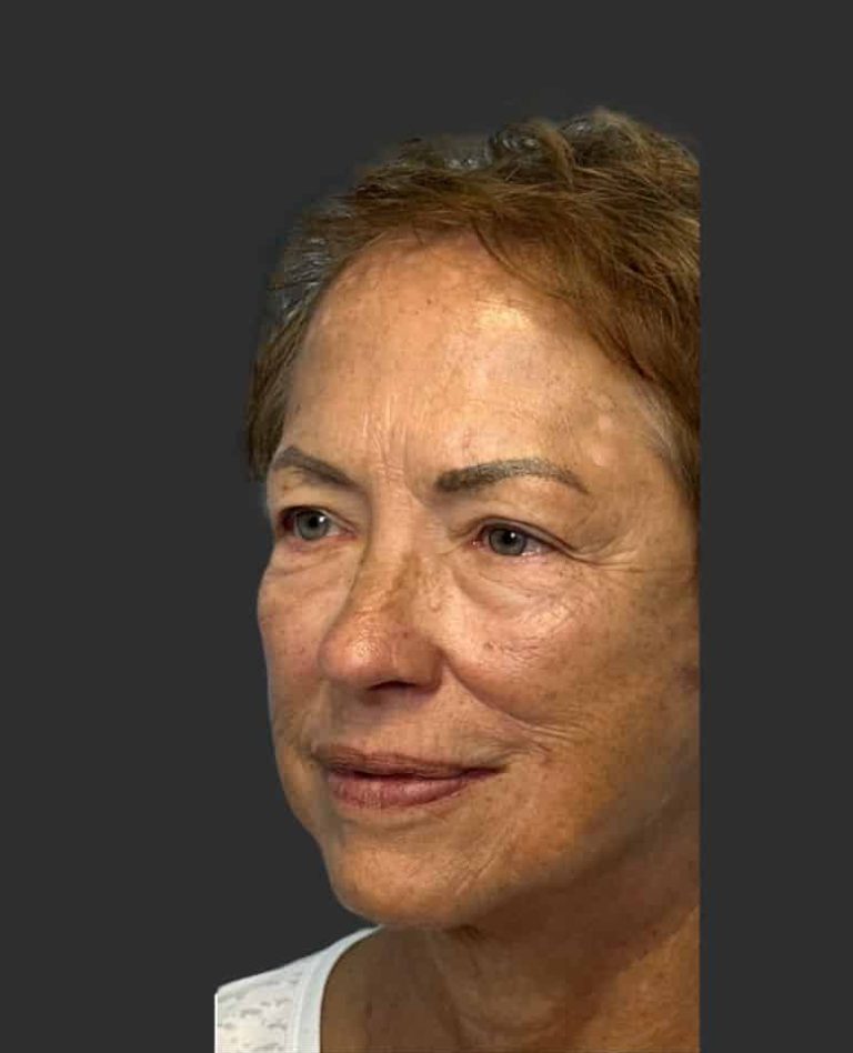 Skin Cancer of the Face - After